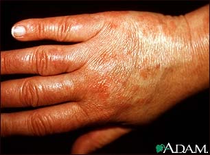 Vasculitis - urticarial on the hand Vasculitis - urticarial on the hand