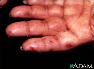 Dermatitis herpetiformis on the hand