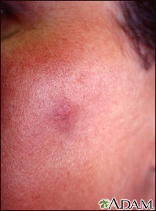 Fixed drug eruption on the cheek Fixed drug eruption on the cheek