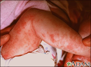 Incontinentia pigmenti on the leg Incontinentia pigmenti on the leg