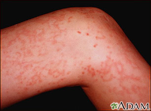 Granulomatosis with polyangiitis on the leg Granulomatosis with polyangiitis on the leg