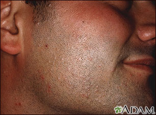 Molluscum contagiosum on the face Molluscum contagiosum on the face