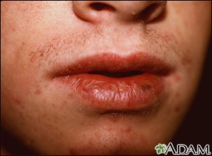 Cheilitis - actinic Cheilitis - actinic