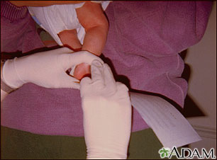 Phenylketonuria test Phenylketonuria test