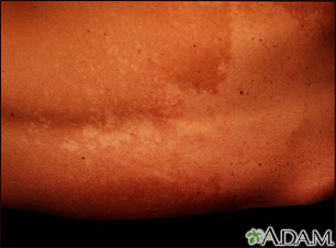 Tinea versicolor - back Tinea versicolor - back