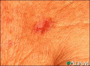 Basal Cell Carcinoma - close-up Basal Cell Carcinoma - close-up