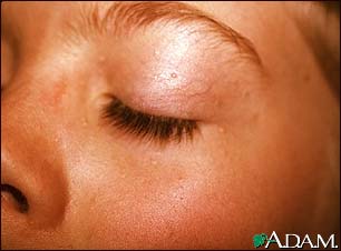 Basal cell nevus syndrome Basal cell nevus syndrome