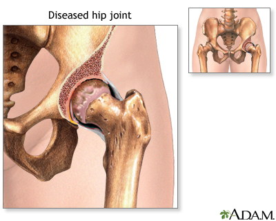 Diseased hip Diseased hip
