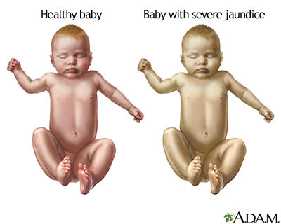 Infant jaundice - Indication Infant jaundice - Indication