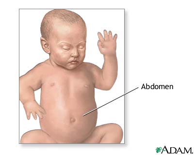 Gastroschisis repair - series Gastroschisis repair - series