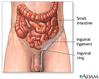 Inguinal hernia repair - series