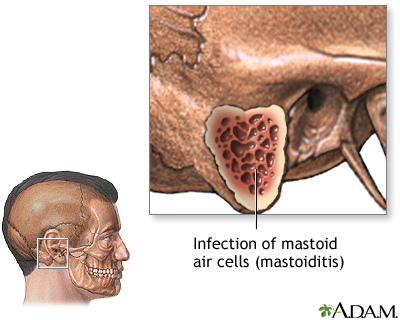 Mastoiditis - Indications Mastoiditis - Indications