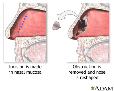 Procedure - Septoplasty