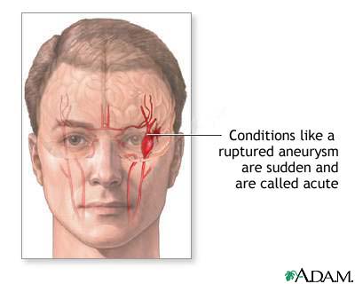 Ruptured intracranial aneurysm Ruptured intracranial aneurysm