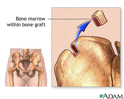 Bone marrow from hip Bone marrow from hip