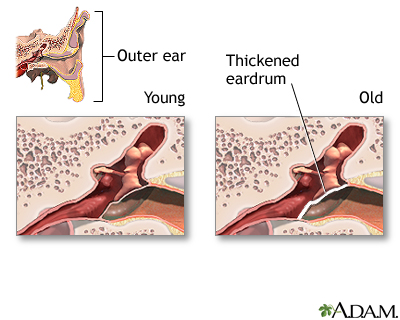 Aging changes in hearing Aging changes in hearing