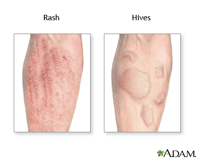 Allergic reactions Allergic reactions