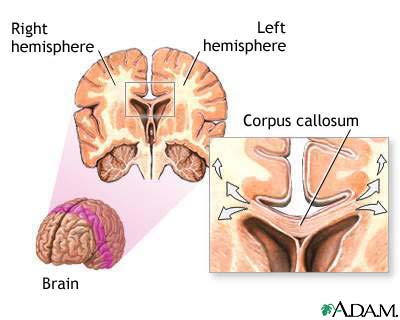 Corpus callosum of the brain Corpus callosum of the brain