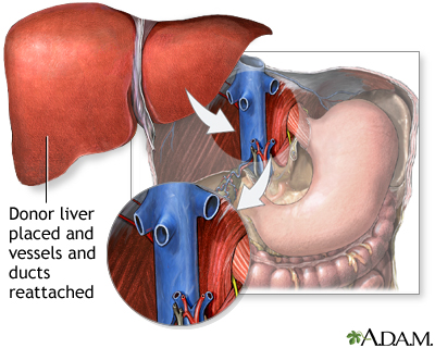 Donor liver attachment Donor liver attachment