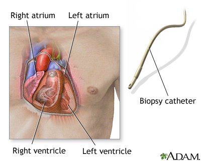 Biopsy catheter