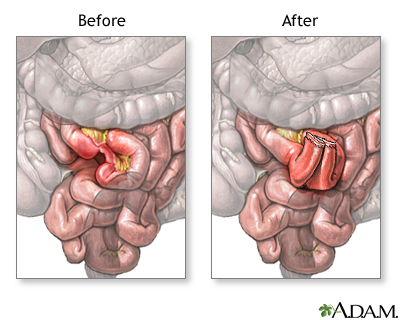 Before and after small intestine anastomosis Before and after small intestine anastomosis