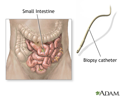 Small intestine biopsy Small intestine biopsy