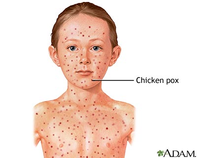Chickenpox Chickenpox