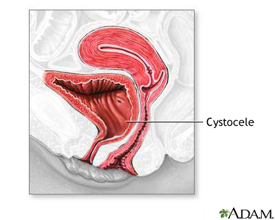 Cystocele Cystocele