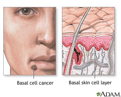 Basal cell cancer Basal cell cancer