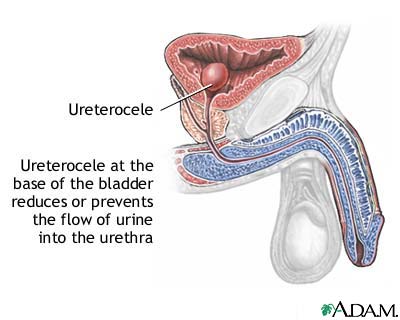 Ureterocele Ureterocele