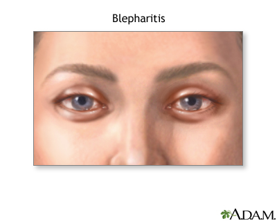Blepharitis Blepharitis