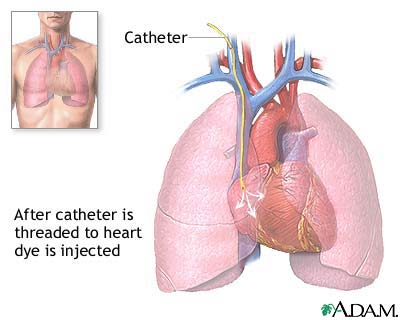 Cardiac catheterization Cardiac catheterization
