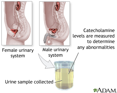 Catecholamine urine test Catecholamine urine test