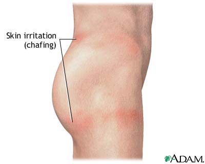 Chafing of the skin Chafing of the skin