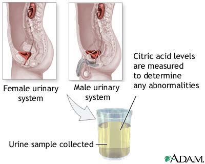 Citric acid urine test Citric acid urine test