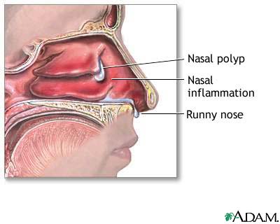 Nasal polyps Nasal polyps