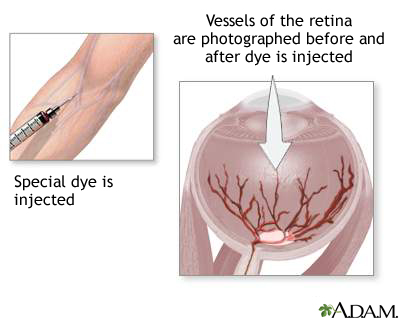 Retinal dye injection Retinal dye injection