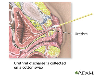Gram stain of urethral discharge Gram stain of urethral discharge
