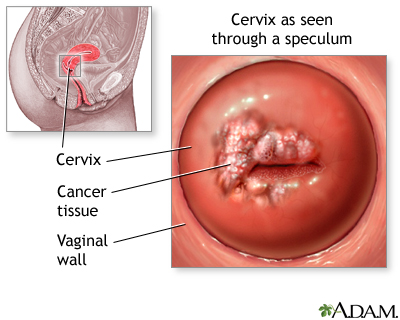 Pap smears and cervical cancer Pap smears and cervical cancer