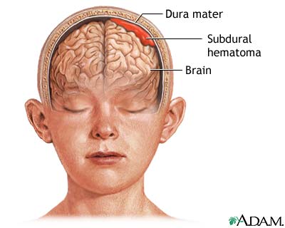 Subdural hematoma Subdural hematoma