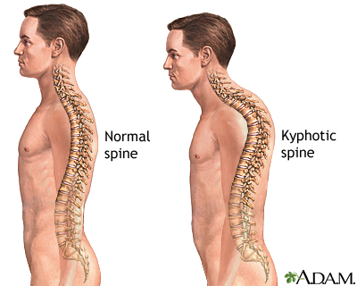 Kyphosis