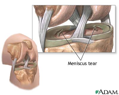 Meniscal tears Meniscal tears