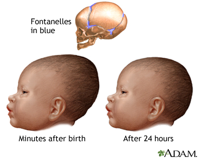 Newborn head molding Newborn head molding
