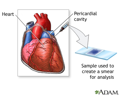 Pericardial fluid culture Pericardial fluid culture