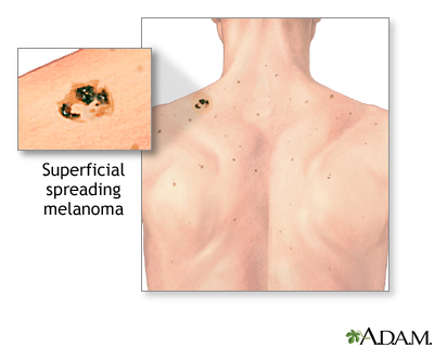 Melanoma Melanoma