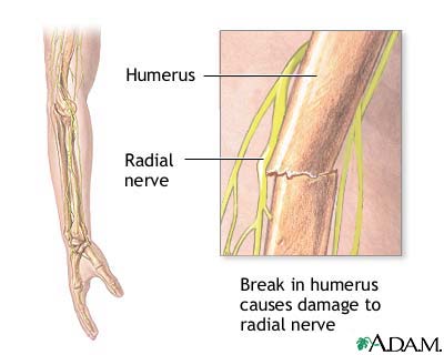 Radial nerve dysfunction Radial nerve dysfunction