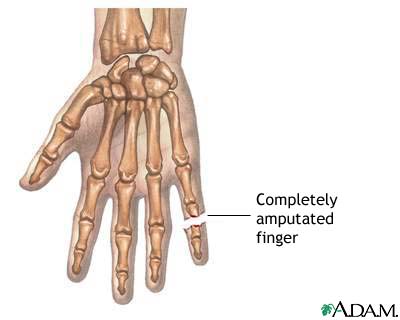 Amputated finger Amputated finger