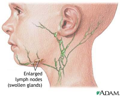 Swollen lymph node Swollen lymph node