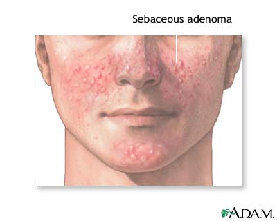 Sebaceous adenoma Sebaceous adenoma
