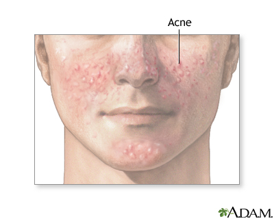 Acne